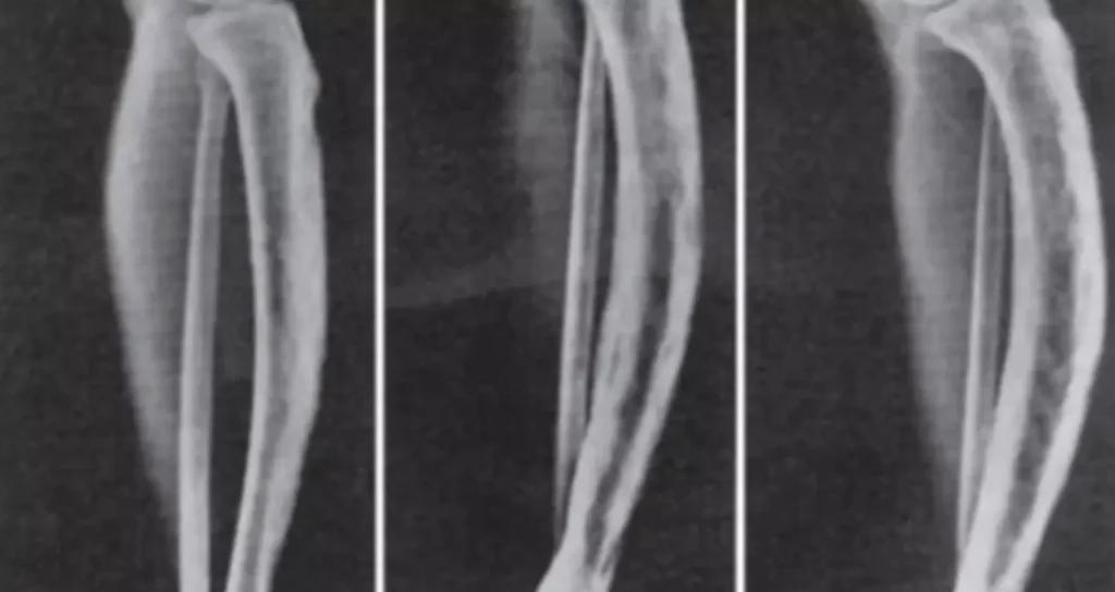 Aposentadoria por Doença de Paget